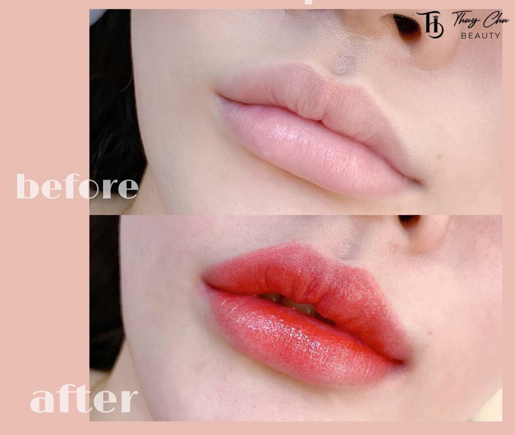 Cô gái có môi thâm trước và sau khi phun môi collagen, thể hiện sự thay đổi rõ rệt