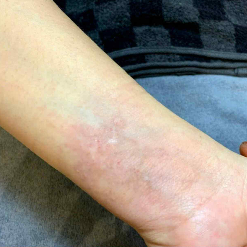 Hình ảnh ngay sau khi xóa xăm lần cuối cùng tại Thẩm mỹ viện Thúy Chu.