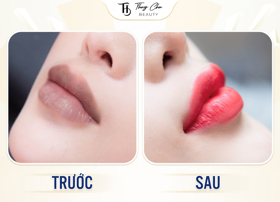 Hình ảnh khách hàng trước và sau khi phun môi collagen tại Hải Phòng