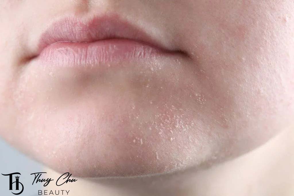 Da khô thường xuất hiện nếp nhăn sớm và dễ kích ứng khi thời tiết thay đổi